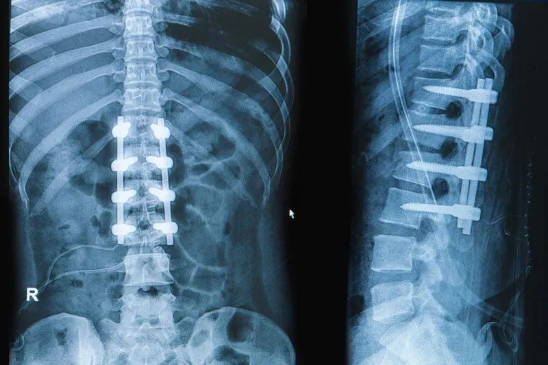 Chinese doctors bring hope to Tanzanian mother after pioneering spine surgery